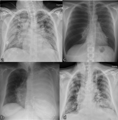 BJR_Radiology's tweet photo. #OpenAccess BJR|Open Review
Imaging in patients with acute dyspnea when cardiac or pulmonary origin is suspected
https://t.co/ZmIrbDIme5
#Radiology #FOAMed #ChestRad #CardioTwitter https://t.co/Resti5CK9O