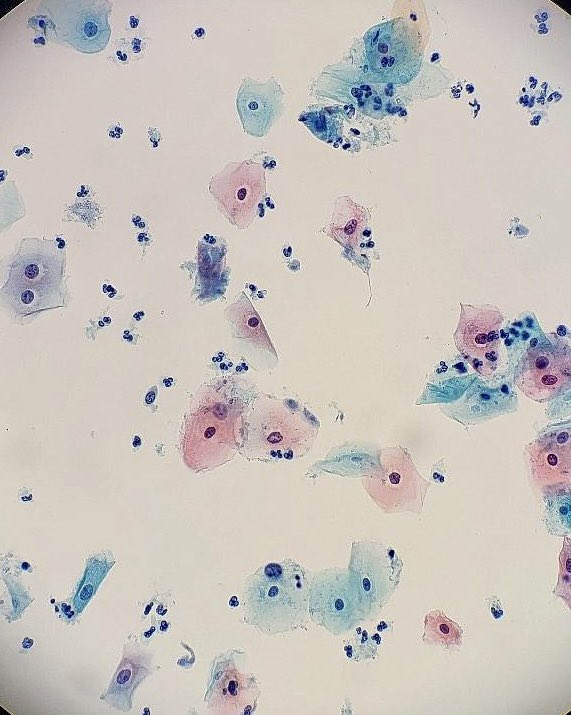 32-year-old female liquid based pap smear. 
Squamous cells with perinuclear  halos in T. Vaginalis infection. NILM #cytopath