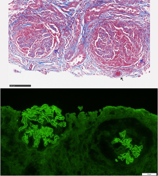GNs keep being reported with #Immunotherapy kidneymedicinejournal.org/article/S2590-… <a href="/KidneyMed/">Kidney Medicine</a> 
Pembrolizumab-Induced Anti-GBM Glomerulonephritis: A Case Report