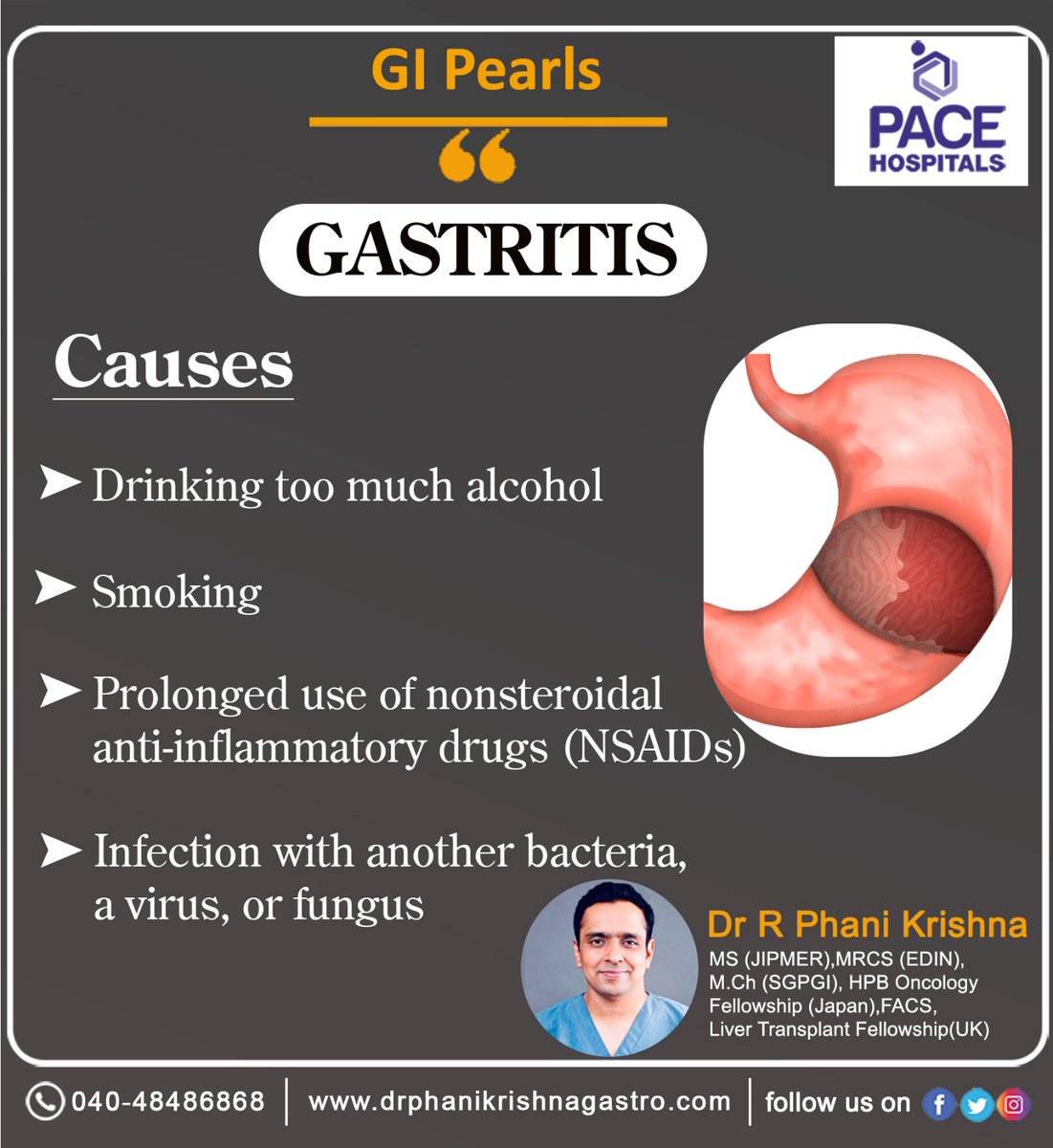 #Gastritis can be #caused by irritation due to #excessivealcoholuse, #chronicvomiting, #stress, or the use of certain #medications.
#drphanikrishnaRavula #surgicalgastroenterologist #Liverproblems #laparoscopicsurgery #gastrodoctor #gastroclinic #besttreatment #besthealthcare