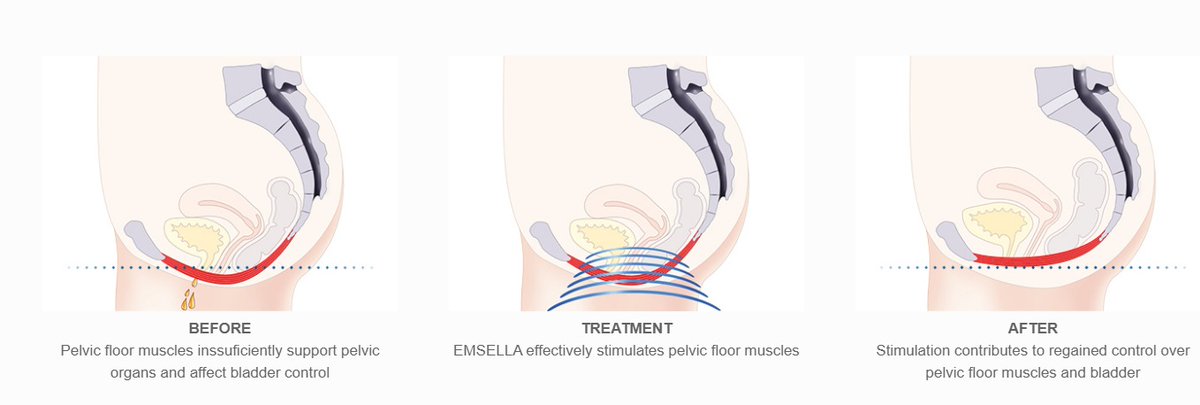 Seeing is believing!
Emsella is a non-surgical, non-invasive treatment for incontinence that is caused by a weakened pelvic floor. The Emsella chair emits a high-intensity focused electromagnetic (HIFEM) wave to create supramaximal contractions within the pelvic floor muscles.