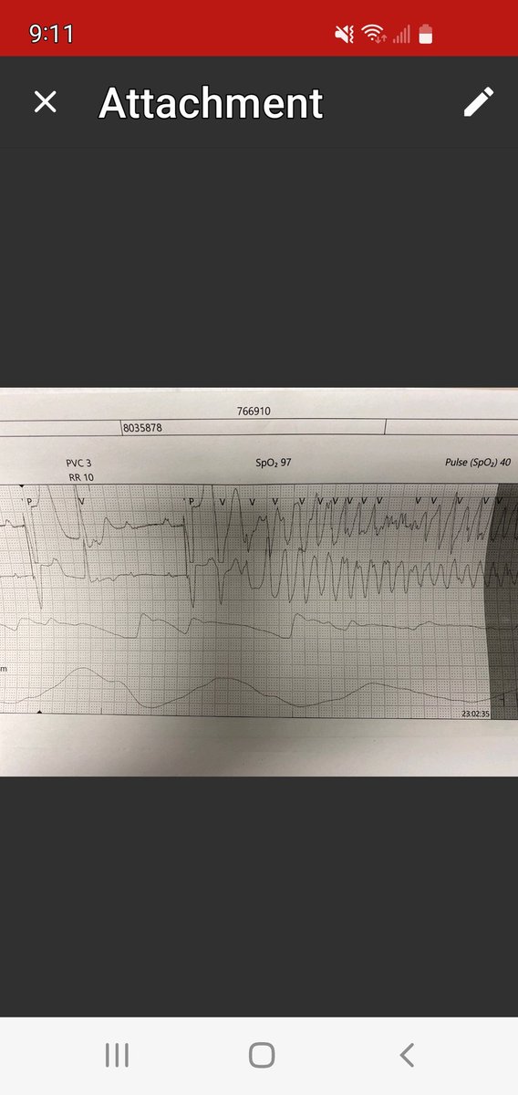 61 F Brady induced Poly VT. Etoh ablation septum -CHB. Not HOCM. Ablation done in prep for perc MVR since LVOT narrow. Vote 1.Ppm 2. IcD <a href="/narrowQRS/">JMC</a> <a href="/DrRoderickTung/">Roderick Tung</a> <a href="/jepoolemd/">Jeanne E Poole</a> #EPeeps <a href="/drbilalmunir/">Bilal Munir</a>