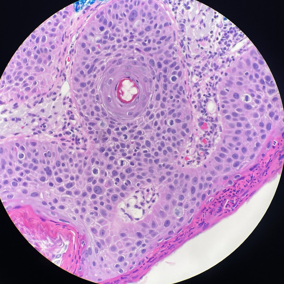megothelioma's tweet photo. Squamous cell carcinoma in situ compared with relatively normal skin. Complete lack of maturation in the epidermis, frequent mitoses, and dramatic nuclear atypia.
#DermPath #PathTwitter #basicpath #dermatology https://t.co/Cb2pDtD2PC
