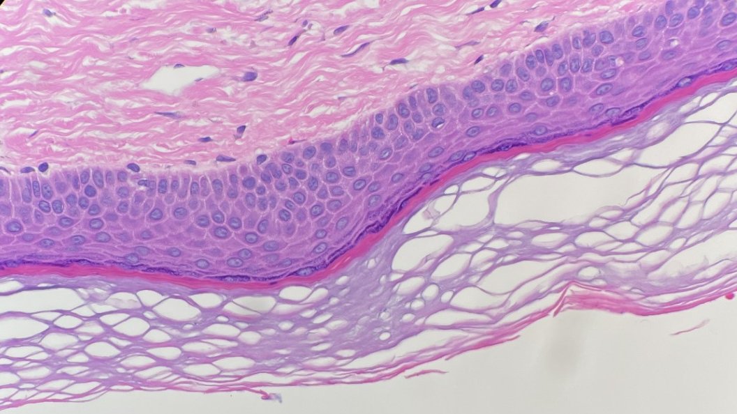 megothelioma's tweet photo. Squamous cell carcinoma in situ compared with relatively normal skin. Complete lack of maturation in the epidermis, frequent mitoses, and dramatic nuclear atypia.
#DermPath #PathTwitter #basicpath #dermatology https://t.co/Cb2pDtD2PC