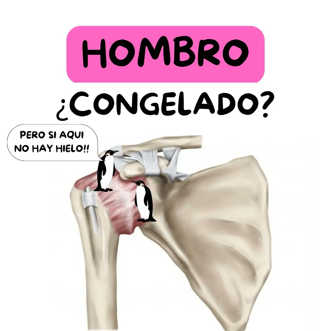 HOMBRO ¿CONGELADO? 💪🏼🧊

➡️ Concepto
➡️ Diagnóstico
➡️ Historia natural
➡️ ¿Fases?
➡️ Fisiopatología
➡️ Causas y factores de riesgo

#fisioterapia  #shoulder #fisioterapia  #traumatologia #dolordehombro #hombrocongelado #frozenshoulder #fisioterapeuta  #lesion #hombro #rehab