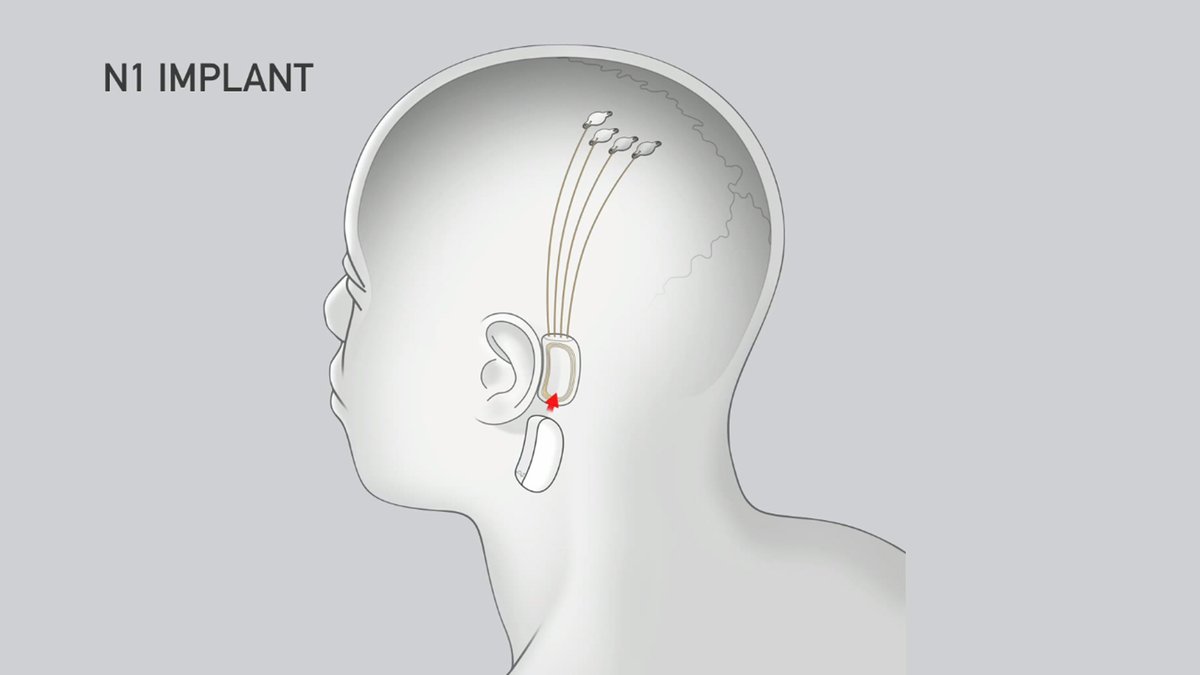 Elon Musk's Brain-chip Startup Approved by FDA for Testing on Humans ow.ly/1K6e50OztRb @neuralink @elonmusk