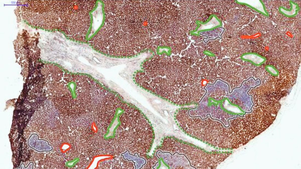 Barts Cancer Institute (Queen Mary) (@qmbci) on Twitter photo Research from <a href="/mcdona02/">Stuart McDonald</a>'s lab at BCI <a href="/QMUL/">Queen Mary University of London</a> has solved a longstanding mystery of how the liver creates new cells – knowledge vital to understanding how and why cell growth spirals out of control in cancer.
📰View the paper: doi.org/10.1016/j.jhep…
👇Or read below… 1/7 Research from <a href="/mcdona02/">Stuart McDonald</a>'s lab at BCI <a href="/QMUL/">Queen Mary University of London</a> has solved a longstanding mystery of how the liver creates new cells – knowledge vital to understanding how and why cell growth spirals out of control in cancer.
📰View the paper: doi.org/10.1016/j.jhep…
👇Or read below… 1/7