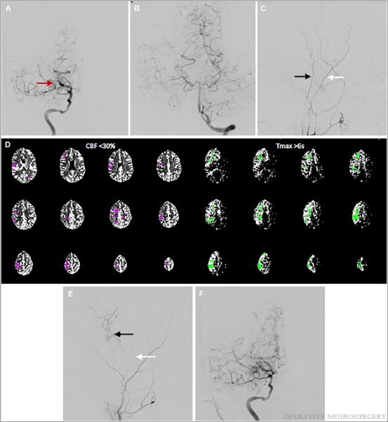 NeurosurgeryCNS's tweet image. #ONSNew Influence of Patient and Technical Variables on Combined Direct and Indirect Cerebral #Revascularization: Case Series bit.ly/3C9kTBz by Rennert et al @UofUHealth @karolbudohoski @rgrandhi @jmascite @haboualshaar @CNS_Update