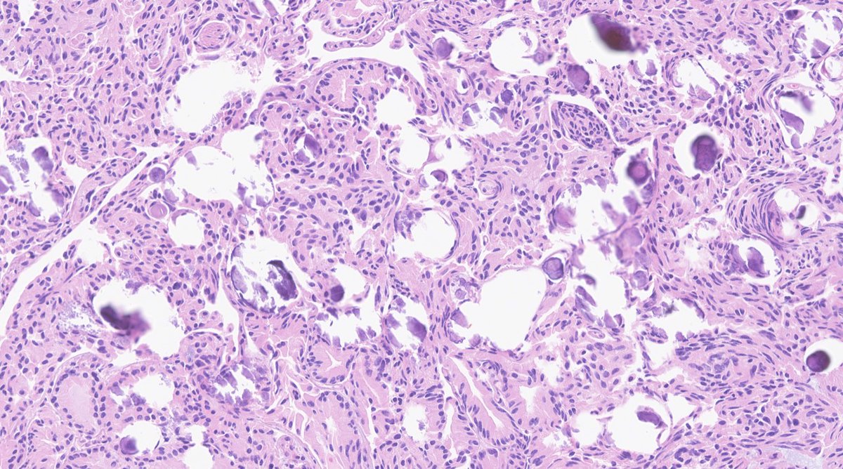 Somatostatinoma (Psammomatous)
-May cause DM, steatorrhea or cholelithiasis
-Somatostatin stain diffusely positive
-Some tumors stain for somatostatin by IHC do not produce somatostatinoma syndrome, so it may not be qualify to be diagnosed as such clinically