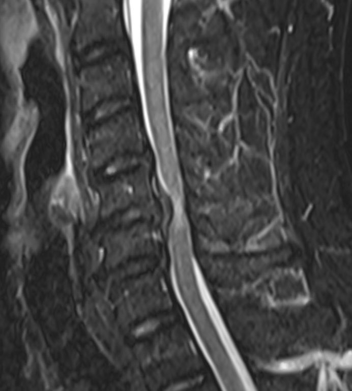 jeroldjusto's tweet photo. Our first Anterior Cervical Discectomy and Fusion using PEEK and Titanium Implant in the province. Thank you very much to the amazing team of doctors, nurses and technicians who helped us with this surgery. https://t.co/3nA5H0T8VJ
