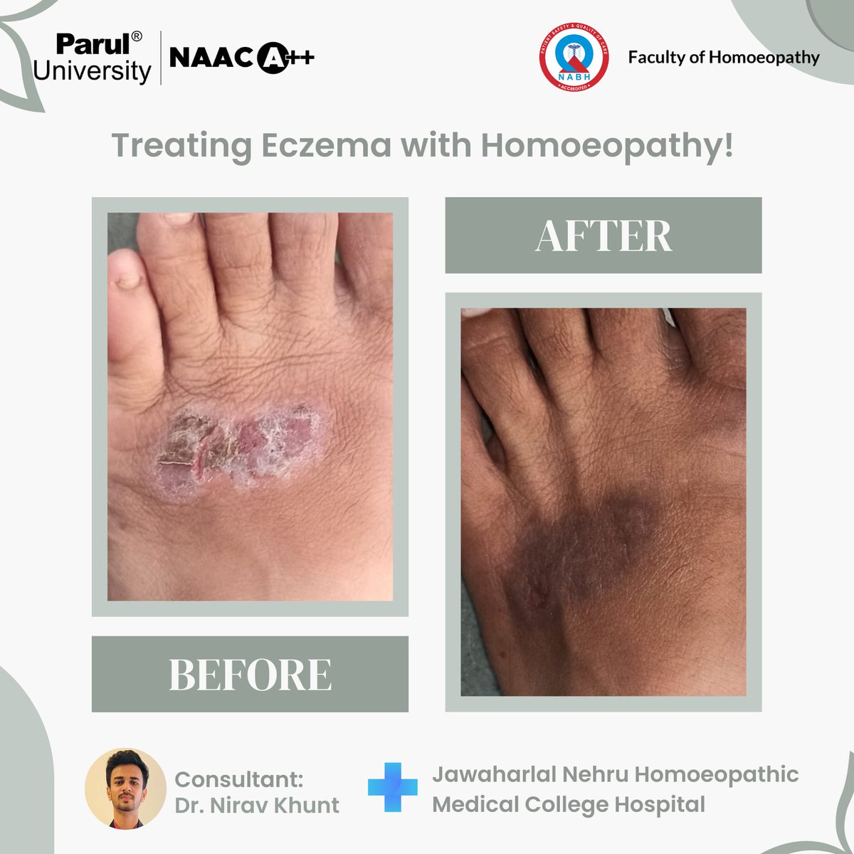 Symptoms can range from itchy, tender fluid-filled bumps to scaly patches on the top of the feet or ankles.
.
.
.
.
#eczema #homeopathyheals #treatment #skin #skindisease #skincare #feet #heals #rash #scales #dryness #dryskin #itching #homeopathy
#paruluniversity
#homoeopathyPU