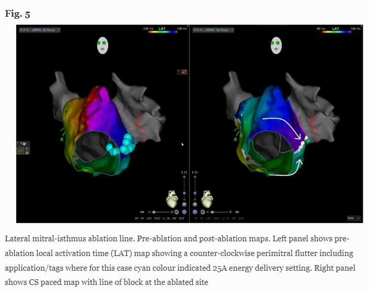 🚨New #OpenAccess Article
@JICE_EP

Focal PFA (FPFA) & Ultrahigh-density Mapping — Versatile Tools for All Atrial Arrhythmias? Initial Procedural Experiences

by @MRuwald @arnejohannesse7 @LockMorten @haugdalm @ReneWorck & @JimHans06778872 

📖🧐doi.org/10.1007/s10840…

#EPeeps