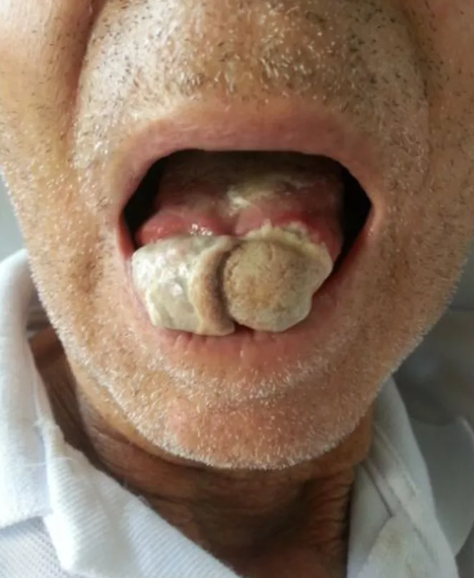 medizzycom's tweet photo. Lingual Necrosis - A rare manifestation of Giant Cell Arteritis

Shared in the MEDizzy App: https://t.co/9nBO1QuBTG

#medicine #medicaleducation #vasculitis #ischemia https://t.co/QPeARNQrmq