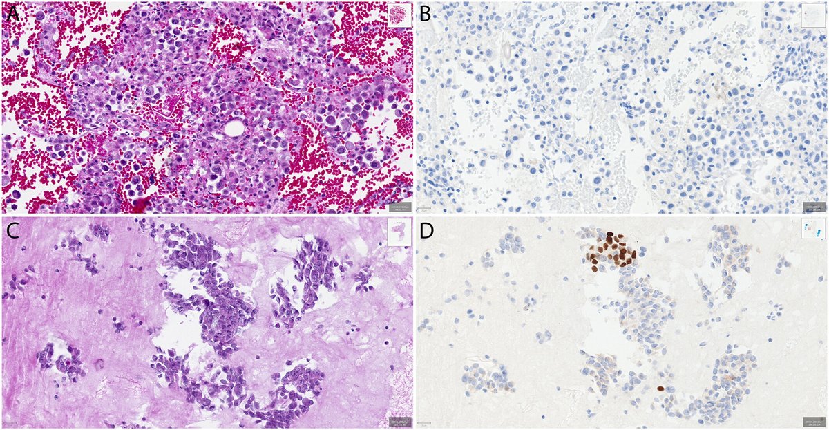 TRENDING & #OpenAccess | SOX17 immunohistochemistry should be included in the workup of differential diagnosis of metastatic gynecologic carcinomas in cytology specimens.

acsjournals.onlinelibrary.wiley.com/doi/10.1002/cn…

#CytoPath