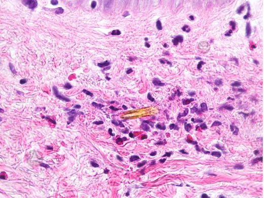 carles_saus's tweet photo. This foreign body in dermis is attracting eosinophils. Urticarform reaction after gardening. 
Do you recognize it ?

#pathology #dermatology #dermpath https://t.co/webyqUFcV8