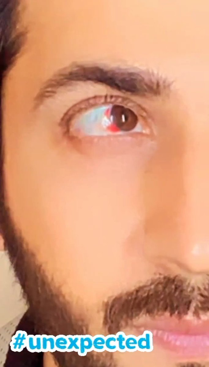 It sure hurts him now😭💔💔
Your safety our hero will soon Recovering❤️
<a href="/DheerajDhoopar/">Dheeraj Dhoopar</a> #dheerajdhoopar