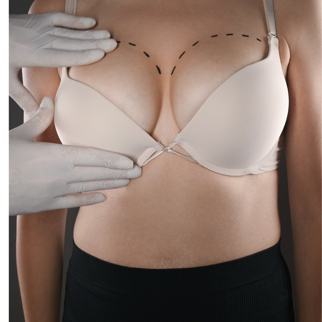 Enhancing a patient's confidence and beauty through cosmetic breast surgery. It's always a privilege to be part of their transformative journey. #BreastSurgery #ConfidenceBoost #BreastAugmentationBirmingham