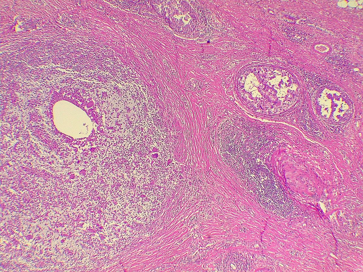 Young age lady, lactating Cystic neutrophilic granulomatous mastitis with DCIS and IDC #PathTwitter