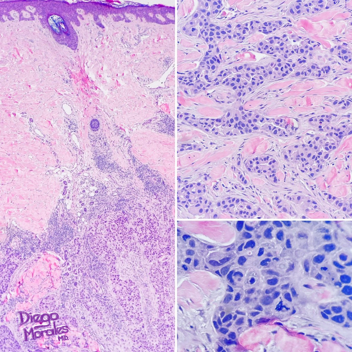 PRAME expression in a cutaneous metastasis of HER2+ breast carcinoma. Some studies (i.e. PMID: 31869767) have reported ⬆️ detection of PRAME in the HER2+ variant of breast CA. It has been correlated with worse prognosis & ⬇️ patient survival. #PathTwitter #dermpath #patologia