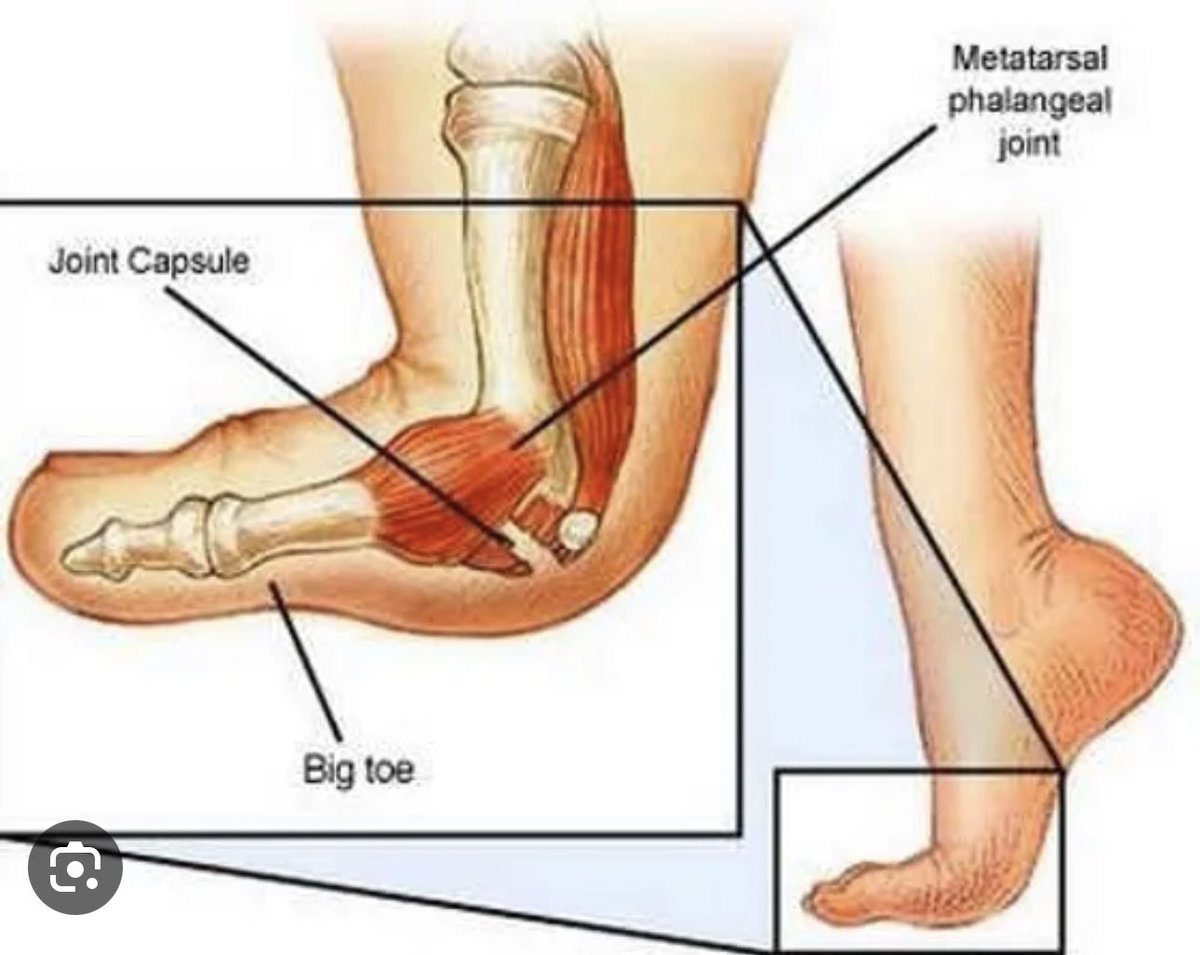 Jesse Morse MD On Twitter This Is What We Call Turf Toe A Very Jesse morse md on twitter this is what we call turf toe a very