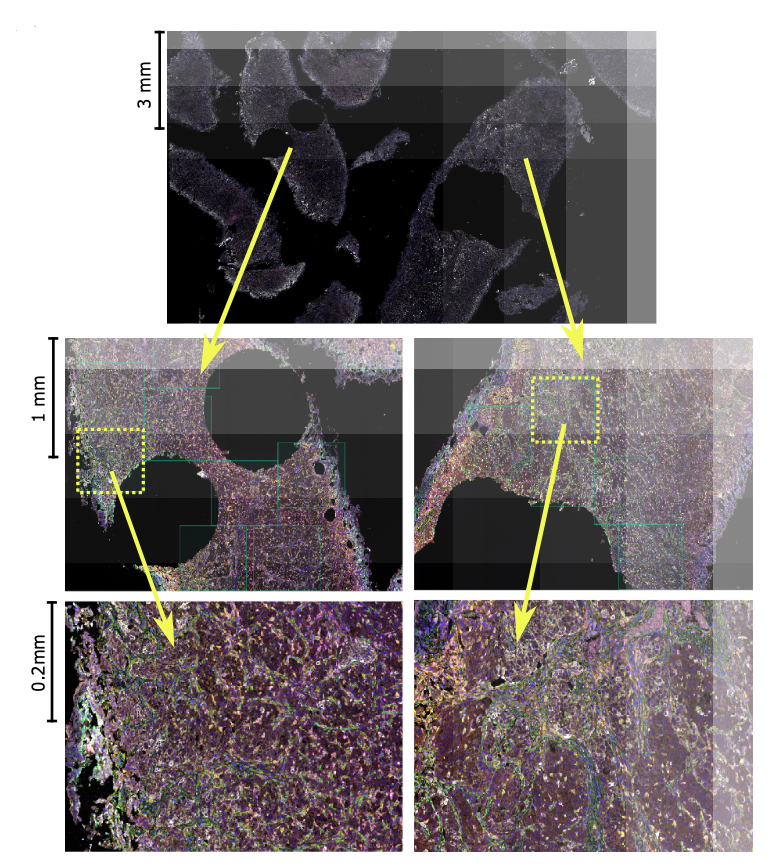 ScienceMagazine's tweet photo. New in @ScienceTM: By analyzing the molecular landscape of bladder cancers in 327 patients, researchers have now identified three unique subtypes of tumors that show predictable responses to immunotherapy with the bacterium Bacillus Calmette-Guérin. https://t.co/SMIcZ2odXj https://t.co/vgSNrkSbHx