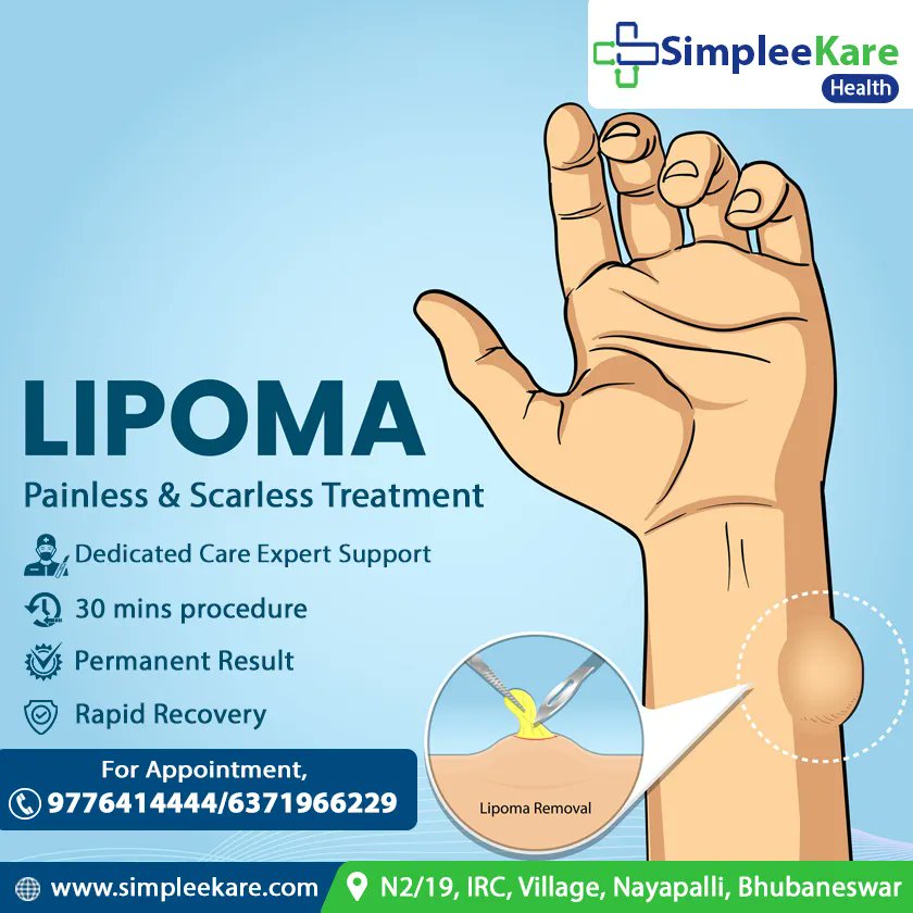 PAINLESS AND SCARLESS LIPOMA TREATMENT
-No Side Effects
-High Success Rate
-30 Minutes Procedure
Book Appointment:
Call: 9776414444 / 6371966229
Visit: simpleekare.com/Lipoma

#lipomaremoval #lipomatreatment #painless #scarless #lipomasurgery #besttreatment #cyst #cystremoval