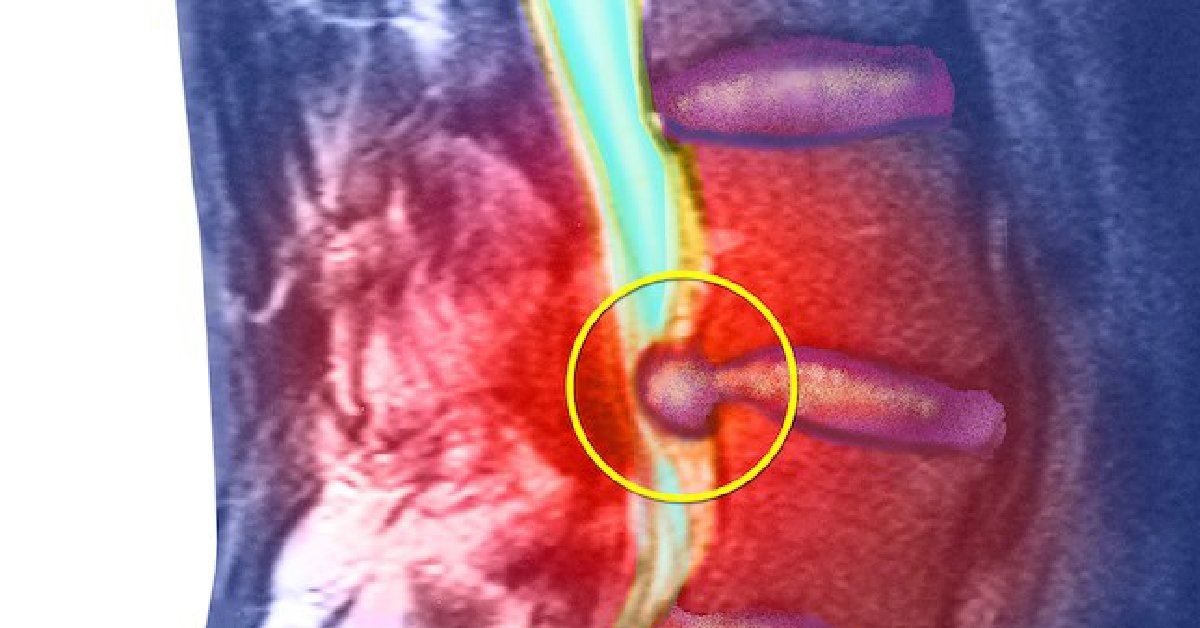 You're more likely to get a herniated disk if you lift, push, or bend a lot or do the same motion over and over.  Sitting all day in the same position, as many office workers do, can also do it. wb.md/3N9R1Lu