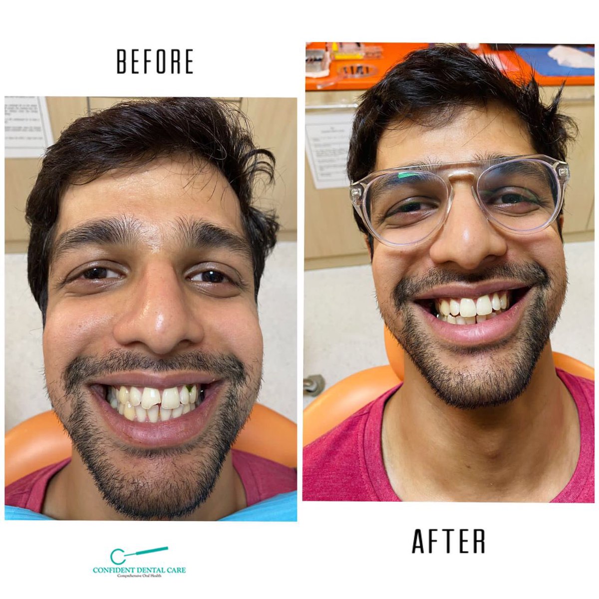 A smile you love can light up the room. Agree? #smilemakeover #bangaloredentist #DentalImplants #braces #orthodontictreatment #clearaligners #compositeveneers
