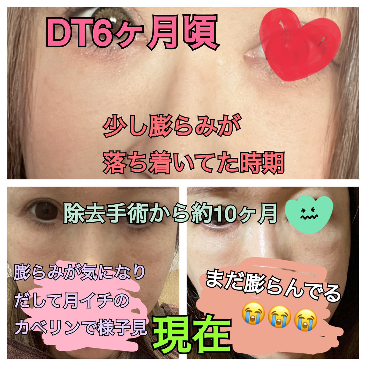 kinakogashi's tweet photo. ぷるぷる注射から2年8ヶ月、今も膨らみや凸凹に悩まされる日々。私の場合打った直後から思い切り膨らんだ。いろいろと修正したけど、少し落ち着いてはまた膨らむ、その繰り返し。ほんと後悔しかない。

★記録として時系列にまとめてみた★ https://t.co/48ioKYsOjj