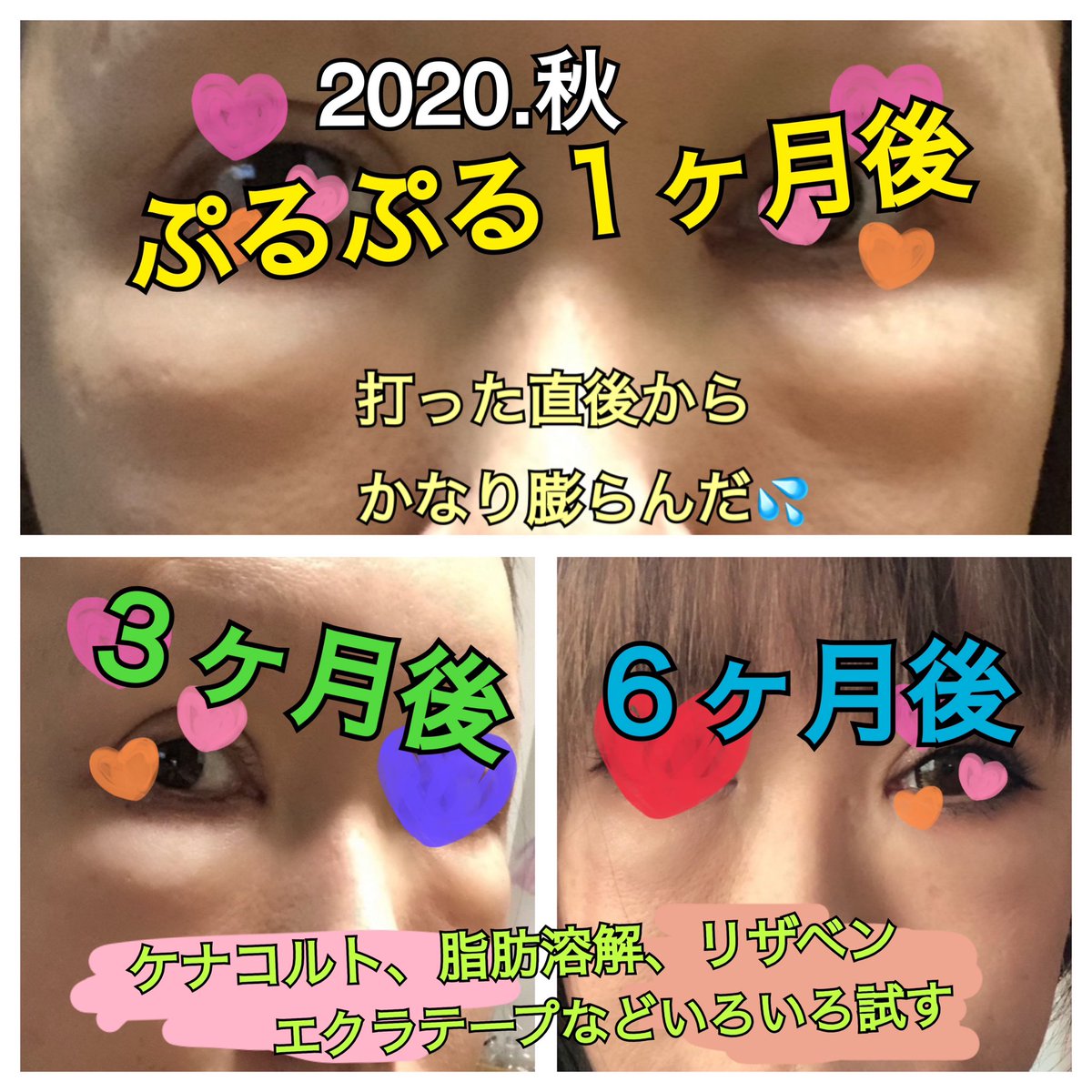 kinakogashi's tweet photo. ぷるぷる注射から2年8ヶ月、今も膨らみや凸凹に悩まされる日々。私の場合打った直後から思い切り膨らんだ。いろいろと修正したけど、少し落ち着いてはまた膨らむ、その繰り返し。ほんと後悔しかない。

★記録として時系列にまとめてみた★ https://t.co/48ioKYsOjj