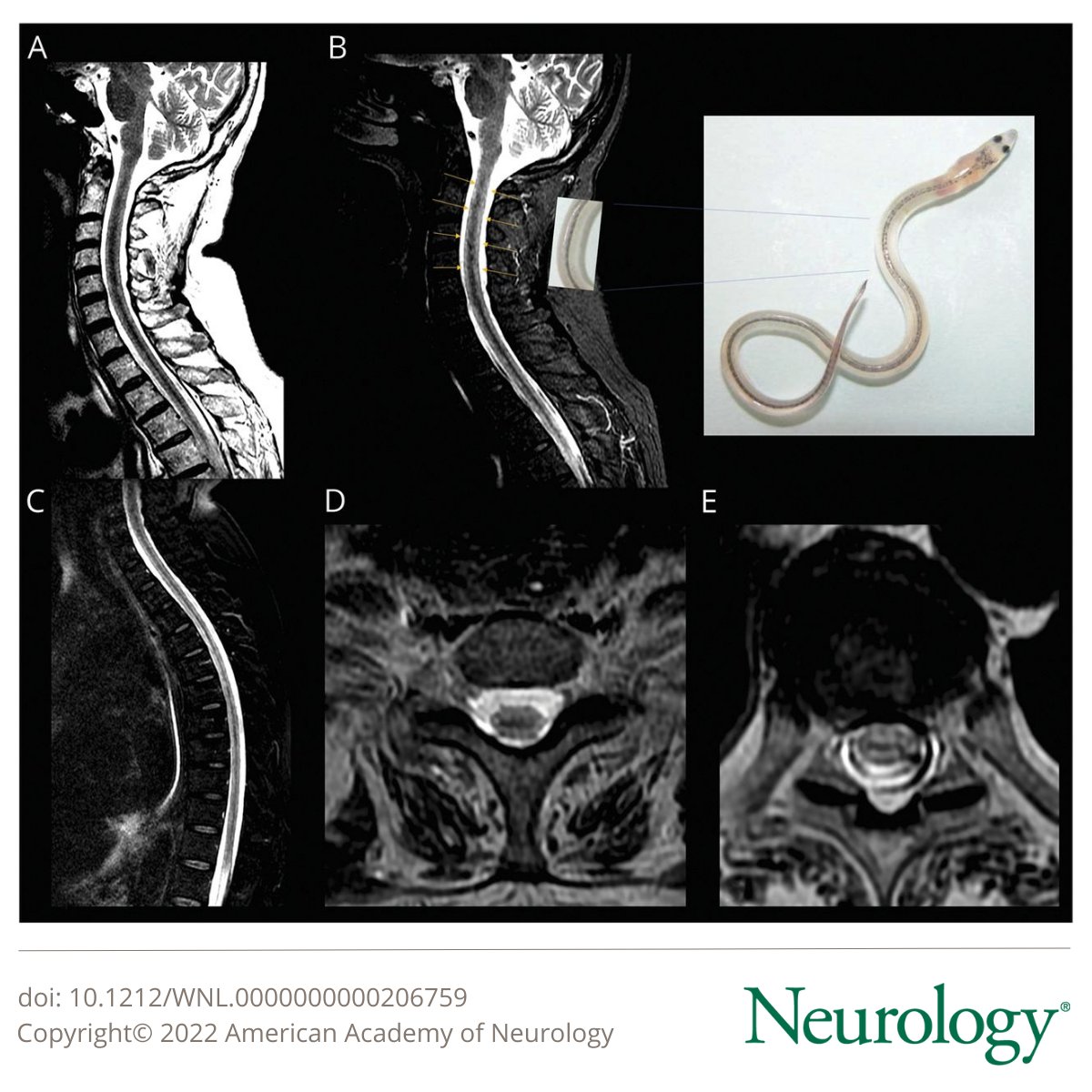 #NeuroImage: “Glass Eel” Sign in Chikungunya Myelopathy bit.ly/41HW1M3

#NeuroTwitter