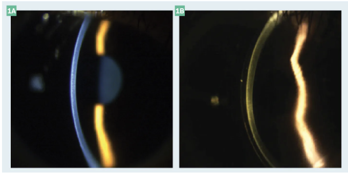 OptometryTimes's tweet photo. Basic and beyond: technology for every level of scleral lens management
More: https://t.co/OVb0TrKJ6E
#Optometry #LensTech https://t.co/aRePNXd6Jx