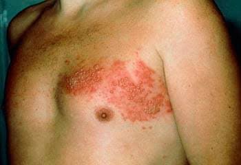 ¿Sabias que existe una vacuna para evitar el herpes zoster?
Se llama Shingrix y se aplican 2 dosis, con un intervalo de 2-6 meses.
Se recomienda para adultos mayores de 50 años. 💉 💉