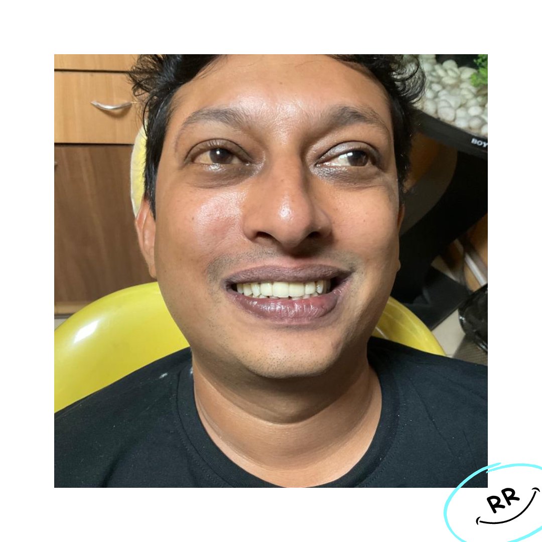 rr_dental's tweet photo. He came to our hospital with a broken tooth and it was way worse. Book your appointments now!

#dentalcrowns #dentalbridges #dentalhospital #dentist #dentaltechnology #vadapalani #tnagar #ashoknagar #kodambakkam #kknagar #annanagar #toothdecay #smile #beforeandafter https://t.co/swXrywddH5