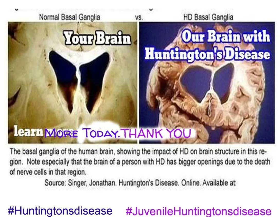AwarenessHD's tweet photo. #CureHD #Jhdkids #huntingtonsdisease #blueandpurple #wehaveaface
#HDresearchselfie
Everyday Is Huntington's disease Awareness day
Get ...Involved with a RT
My Family Thanks You
#LetsTalkABoutHD
#huntingtondisease
#juvenilehuntingtonsdisease
#huntingtonsdisease https://t.co/llwPn8oXuN
