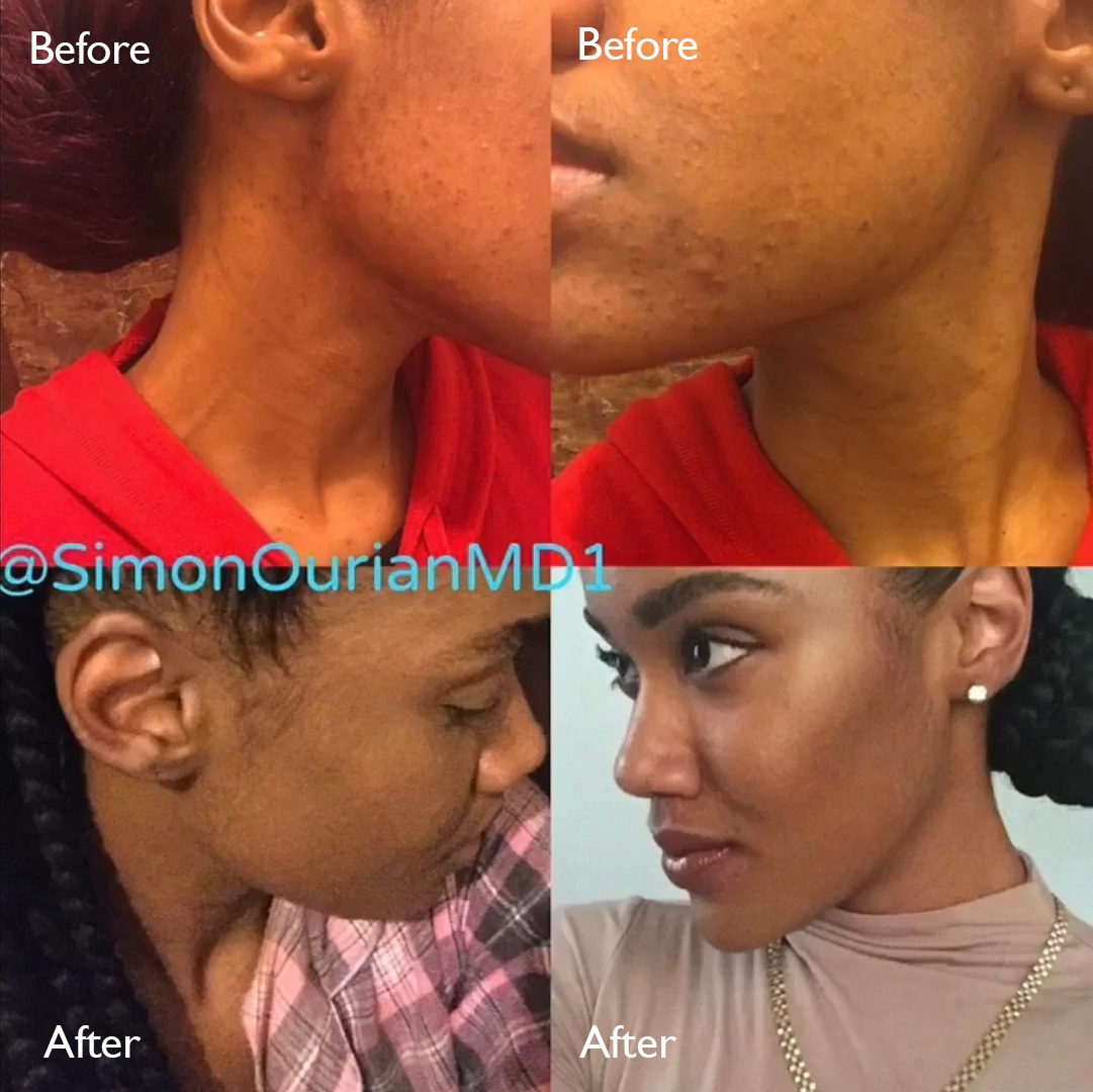 Non-Surgical Removal of Acne and Acnescar

#inflamedpimples #acnetreatment #skincare #simonourian #epione #epionebeverlyhills
#acnescars #doctor #acnetreatment #scarremoval #facialaesthetics #skinperfection #beautyexperts