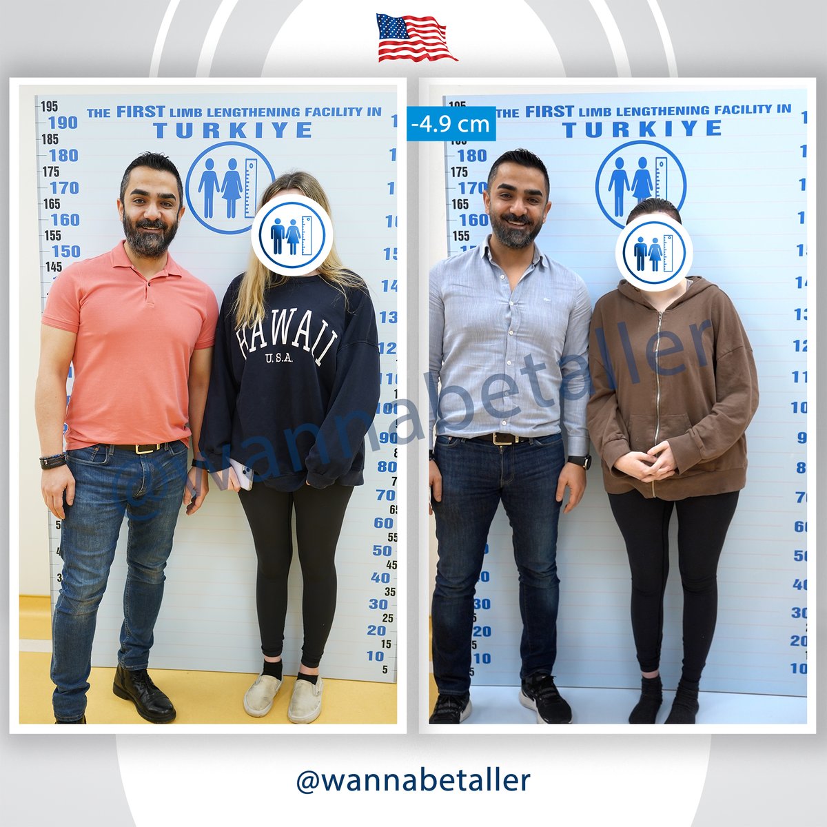 LengthenSurgery's tweet photo. Our American's height, which used to be 173 cm, has become 168.1 cm after she had her limb reduction surgey from femur and shortening 4.9 cm.
Pre-Surgery Height: 173 cm
Post-Surgery Height: 168.1 cm
#limblengthening #limbreduction #limbreductionsurgery #femur #longstature https://t.co/hmwrwfubxC