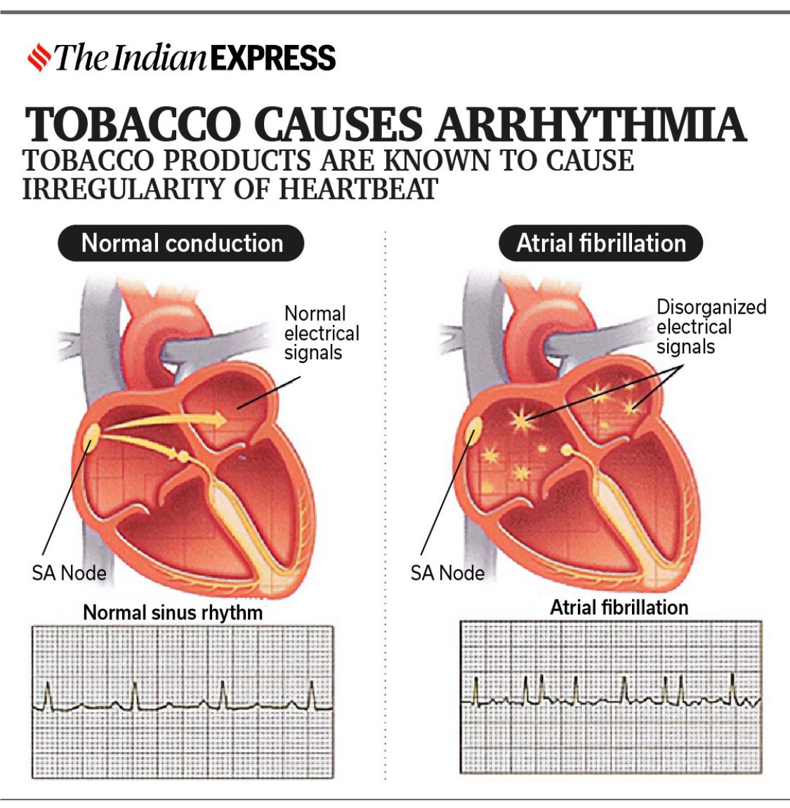 IndianExpress's tweet image. #Replug | #WorldNoTobaccoDay2023: 🚬🚫

♦️ Tobacco use promotes both atherosclerosis (fat deposition coupled with fibrosis) in the vessel walls and thrombosis (blood clot formation) on the damaged vessel walls. 

♦️ Composition and levels of blood fats are affected by smoking.