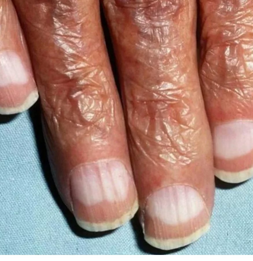 Oren Gottfried MD On Twitter anyone Know What These Nails Are oren-gottfried-md-on-twitter-anyone-know-what-these-nails-are