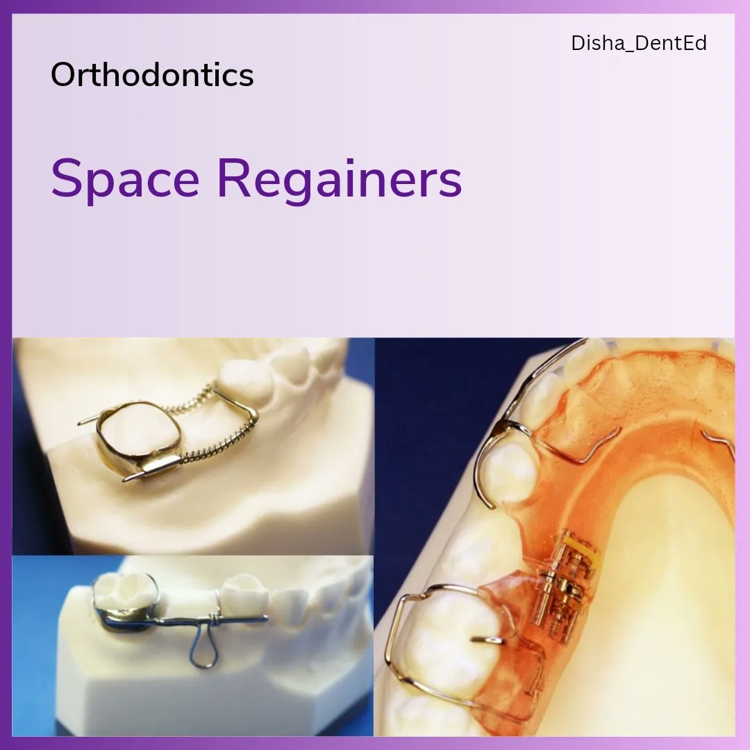 Disha_DentEd's tweet photo. Orthodontics _ Post 5
Topic: Space Regainers
1. Definition
2. Common causes of space loss
3. Space regainers
- Gerber space regainer
- using Jack screw
- using cantilever spring
#dentistry #dentalstudent #dentalnotes #dentalexam #dental #dentistrynotes #orthodontics https://t.co/6SudPBc6GE