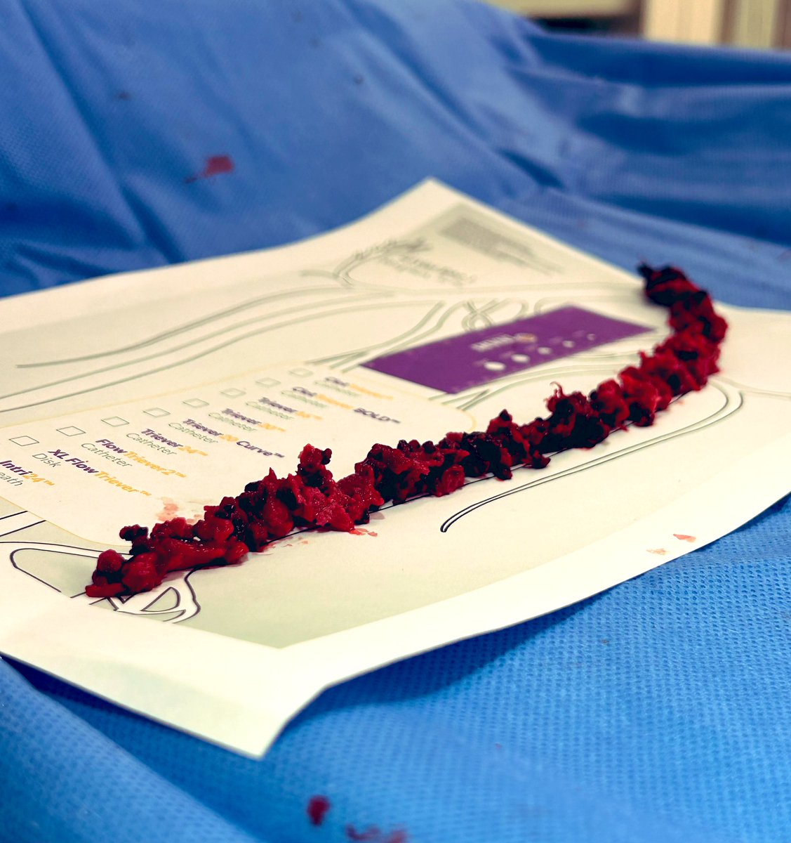 Jules Catt (@drjulescatt) on Twitter photo Liverpool Public Hospital Interventional Radiology using the newest device for DVT thrombectomy with high yield clot removal. Great team effort for best patient outcomes.<a href="/InariMedical/">Inari Medical</a> #clottreiver <a href="/Hannah_Ireland/">Hannah Ireland</a> #twittIR #irad Liverpool Public Hospital Interventional Radiology using the newest device for DVT thrombectomy with high yield clot removal. Great team effort for best patient outcomes.<a href="/InariMedical/">Inari Medical</a> #clottreiver <a href="/Hannah_Ireland/">Hannah Ireland</a> #twittIR #irad