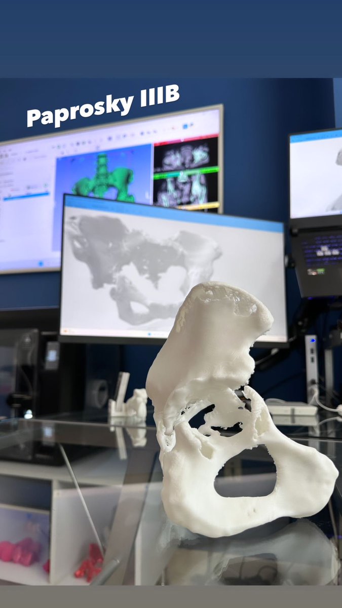OrtoDrJuarez's tweet photo. Defectos acetabulares #orthotwitter #3dcot https://t.co/lcI56htT6B