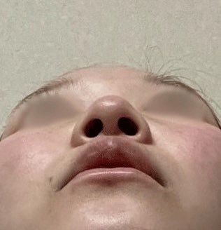 99O1O1's tweet photo. 遅くなりましたがバナナ美容整形外科さんで鼻フルしてから1ヶ月経ちました @bananaps__ 🍌💕

骨切り幅寄せもした為腫れとアザは思ったより長く続きましたが鼻穴の形と横顔が本当に綺麗になって大満足です😭💕 https://t.co/FZNITjq3Oa
