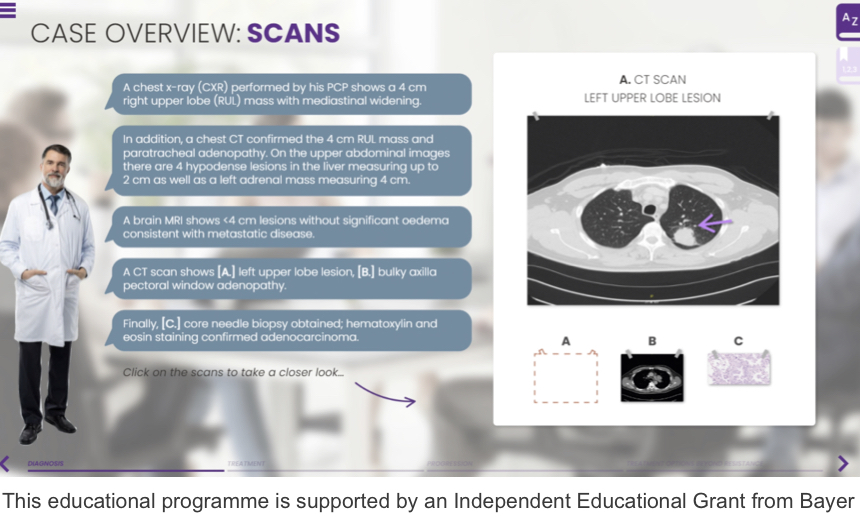 PresOnc_Connect's tweet image. 🔥Out now
In this interactive pt case study learn about the treatment &amp;amp; diagnosis of #TRK positive #lungcancer at initial diagnosis &amp;amp; after 2yrs disease progression

Which clinical decisions will you make?
Will this programme change your approach
ow.ly/2F3x50OzU23

#MedEd