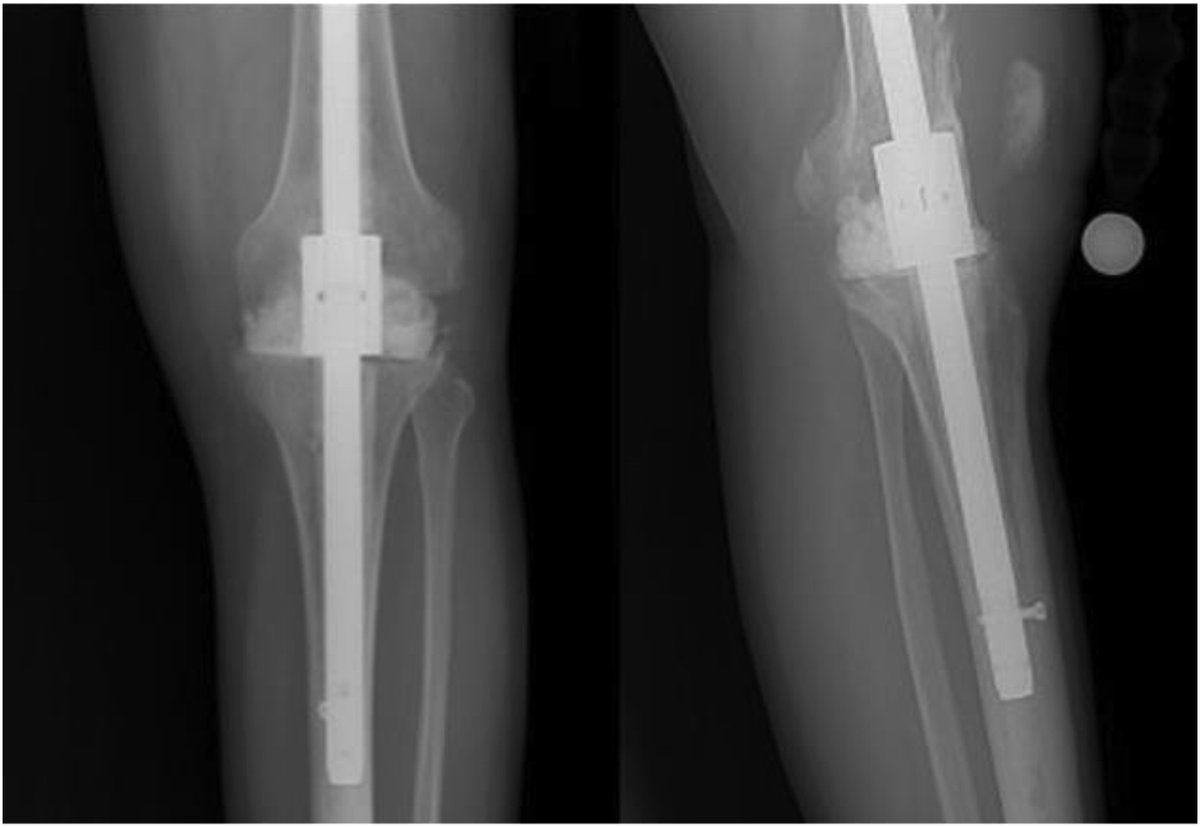 JArthroplasty's tweet photo. Within this cohort, infection eradication and spacer exchange rates were noninferior among #TKA spacers. Functional spacers may allow for earlier return to daily living compared to nonfunctional, without sacrificing outcome.

Read more for free here:
https://t.co/mHnZe023AN https://t.co/CjeEY6vgue