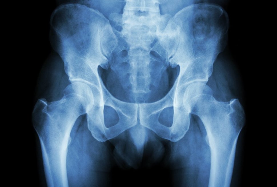 For every millimeter decrease in #jointspace, the odds of conversion to total hip arthroplasty increased by a factor of 2.5. medilink.us/bm3l  #medtwitter #hipsurgery