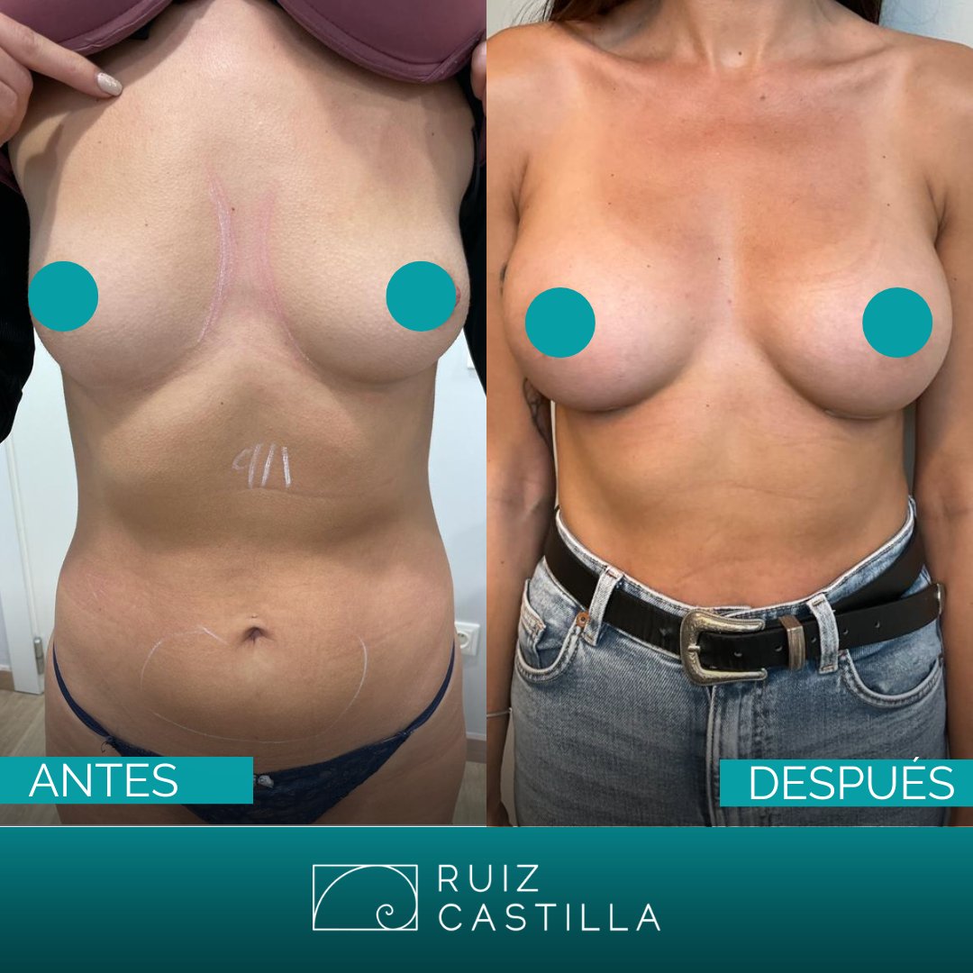 RuizCastilla's tweet photo. Os presentamos un nuevo caso de aumento de mama realizado por la Dra. Mireia Ruiz, en el que se opta por emplear implantes ergonómicos + #lipofilling.
El después es transcurrido 5 meses tras la intervención.
@quironsalud @QS_Dexeus @QS_Barcelona @mireiaruizcast1 https://t.co/K30tgKUDvo