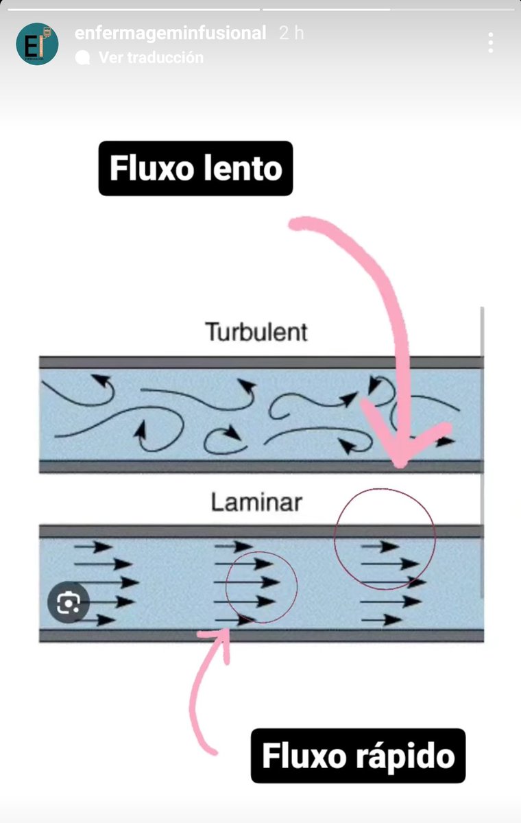 GilSalut's tweet photo. Comparto esta imagen muy ilustrativa sobre por qué realizar lavado pulsátil o intermitente, push-stop o flushing.
Con el permiso de @enfermageminfusional, cuenta sobre AV y TI.
Nunca viene mal un recordatorio.
Y vivan las infografías, gran herramienta de difusión 🙌 https://t.co/PzJAKmcgzu