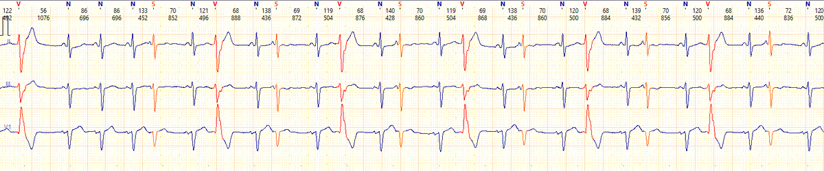 Мкс Рмах (@maxromanchenko) on Twitter photo Colleagues, what is the correct name for such arrhythmia combination? Alternating bigeminy? Atrial/ventricular quadrigeminy? Sinus bigeminy? Any ideas?
<a href="/RobertHermanMD/">Robert Herman, MD, PhD</a> Colleagues, what is the correct name for such arrhythmia combination? Alternating bigeminy? Atrial/ventricular quadrigeminy? Sinus bigeminy? Any ideas?
<a href="/RobertHermanMD/">Robert Herman, MD, PhD</a>