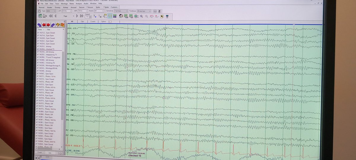 pnolan99's tweet photo. Interesting experience. Had my first EEG done by one of our @atusligo_ie @atu_ie MSc Clinical Measurement Physiology students during their end of placement assessment.
Many thanks to Marcella in Neurophysiology SUH for facilitating placement and assessment
@GeorginaKilcoy3 https://t.co/4WbkTOL2Iv